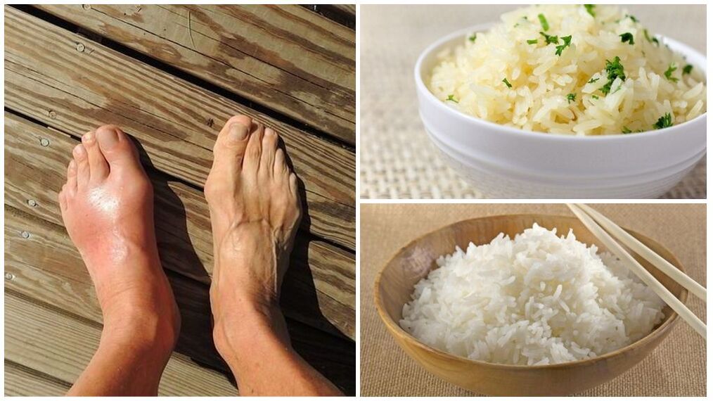 يوصى باتباع نظام غذائي يعتمد على الأرز لمرضى النقرس. 